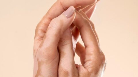 FDA aprueba ruxolitinib tópico para el vitíligo no segmentario